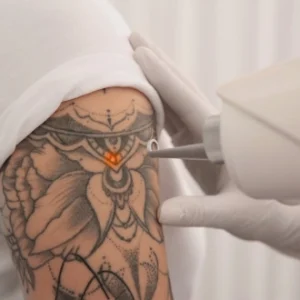 Rio Tan Laser Tattoo Removal